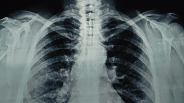 医生的手在胸部x光片上显示受感染的肺部区域。哮喘、COVID-19、冠状病毒或肺炎诊断概念视频下载