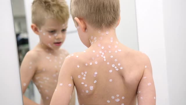 小男孩在镜子前审视自己。水痘病毒或水痘泡疹的儿童视频下载