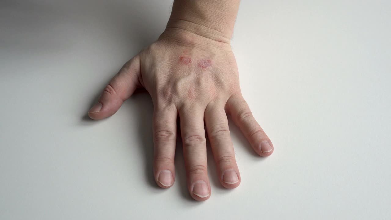 一个不知名的成年男性抓他的手，这是孤立的白色背景与复制空间。手上有皮炎和疥疮的迹象。皮肤过敏的概念。前视图。4 k。视频素材