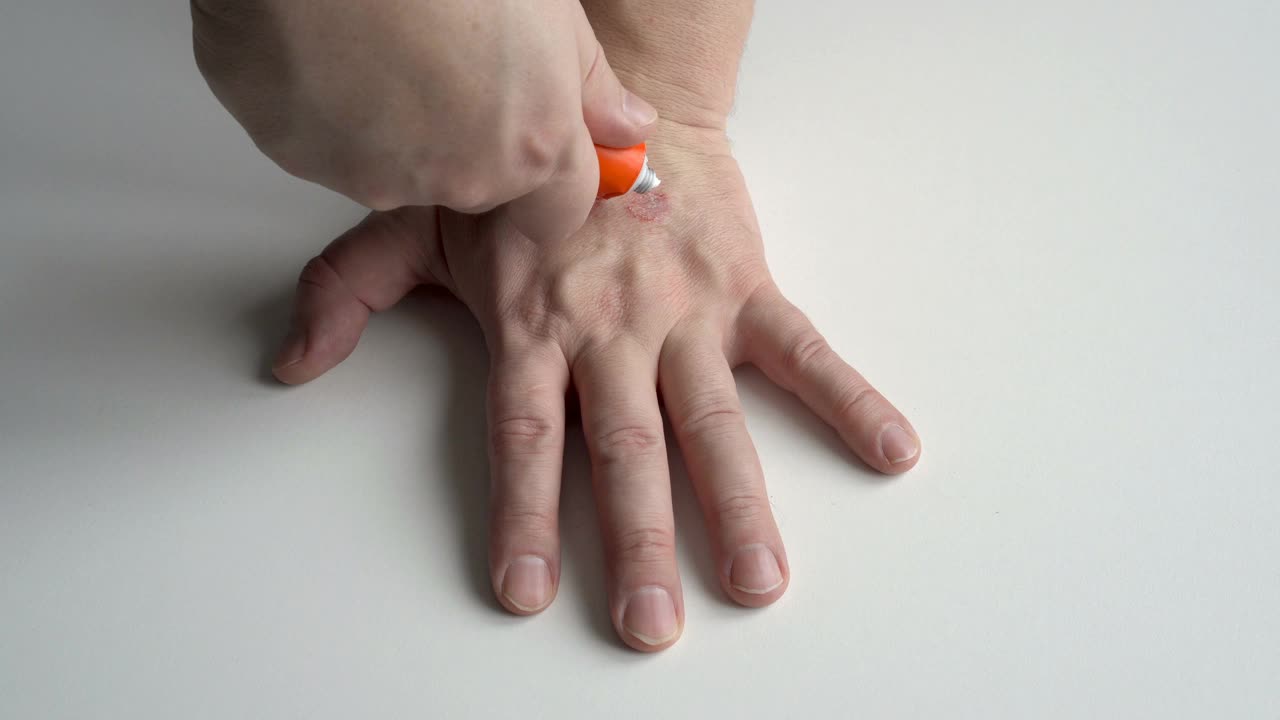 一名成年男子在手上涂抹治疗药膏，手上有皮炎和疥疮的迹象。手是孤立的白色背景与复制空间。不知名的。详细的计划。前视图。4 k。视频素材