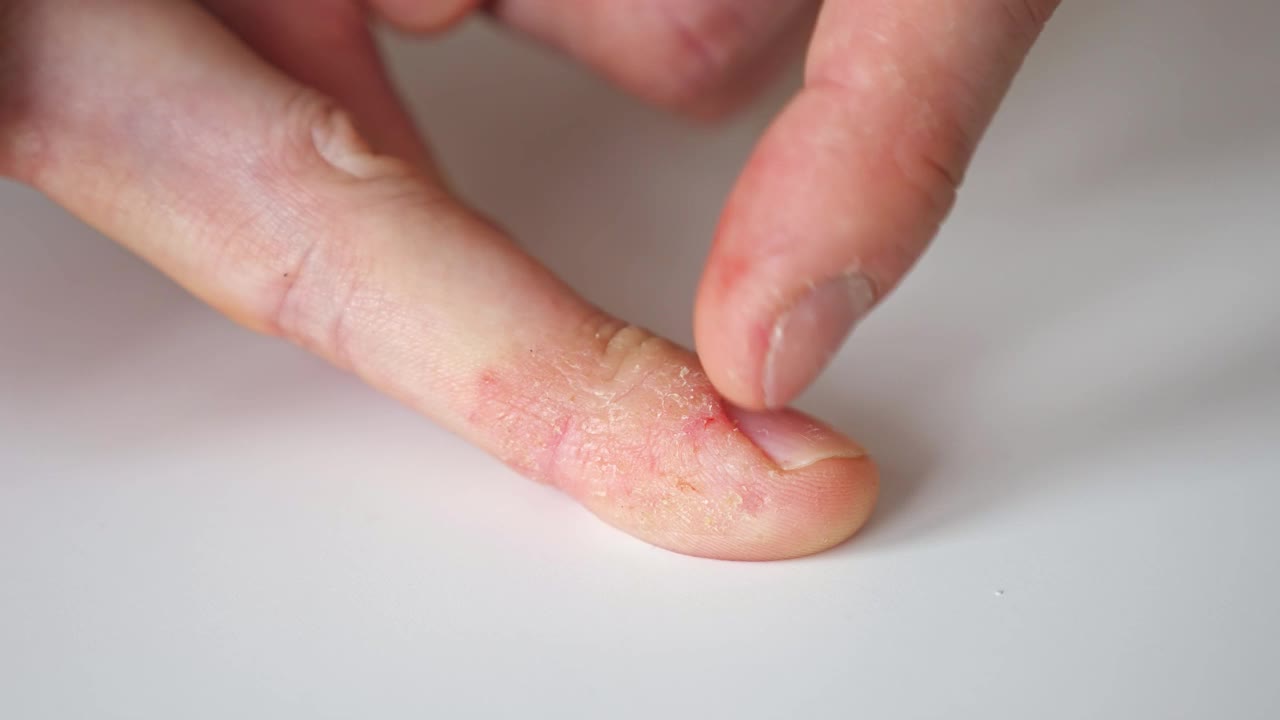一个患有牛皮癣和湿疹的人的手指。视频下载
