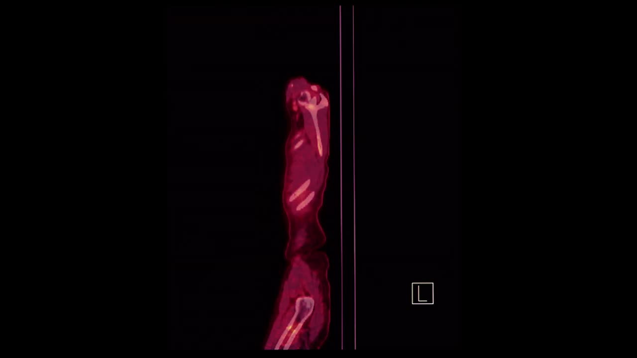 PET CT(正电子发射断层扫描)的整个人体三维渲染图像红色色调矢状面检查肿瘤术后复发。视频下载