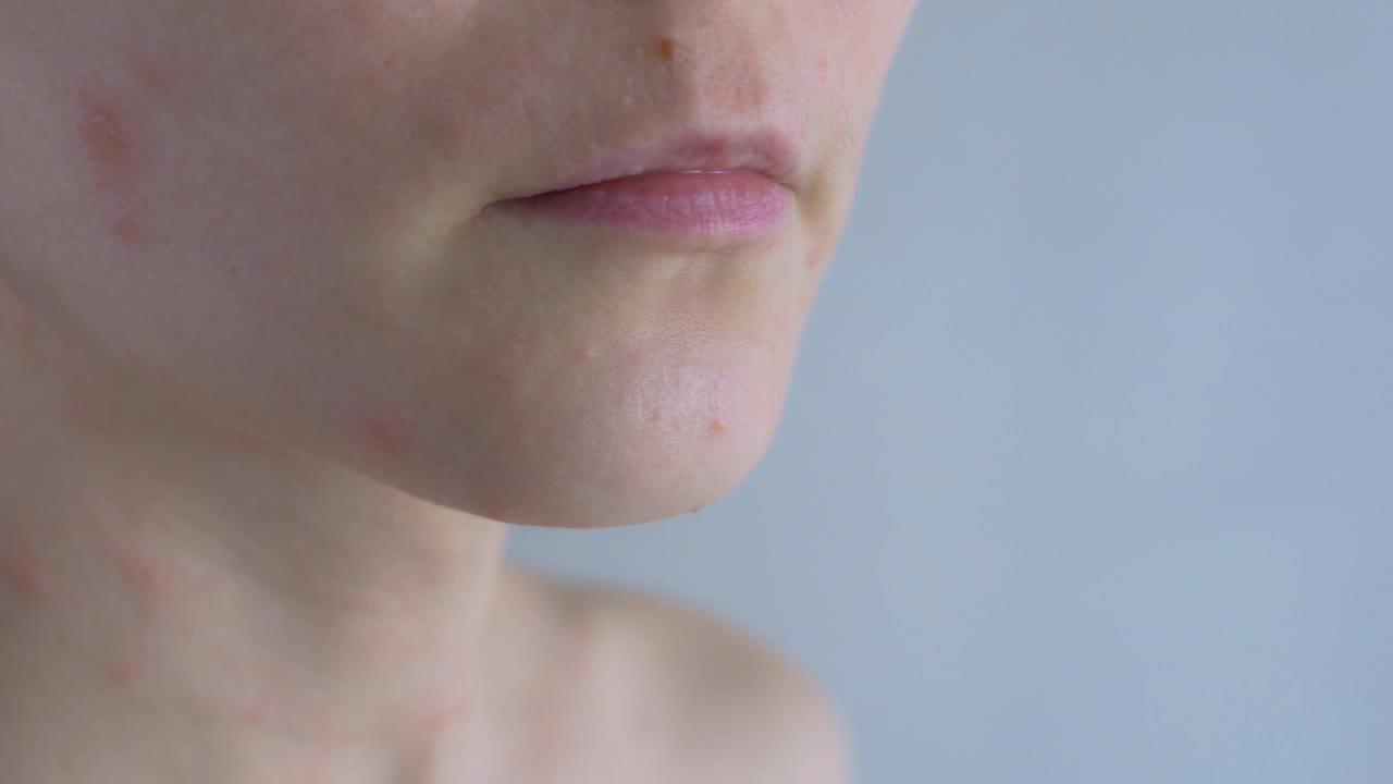 皮肤有问题的女人。在妇女的脸部和颈部，出现了各种大小的红斑。过敏性皮炎。特写镜头视频素材