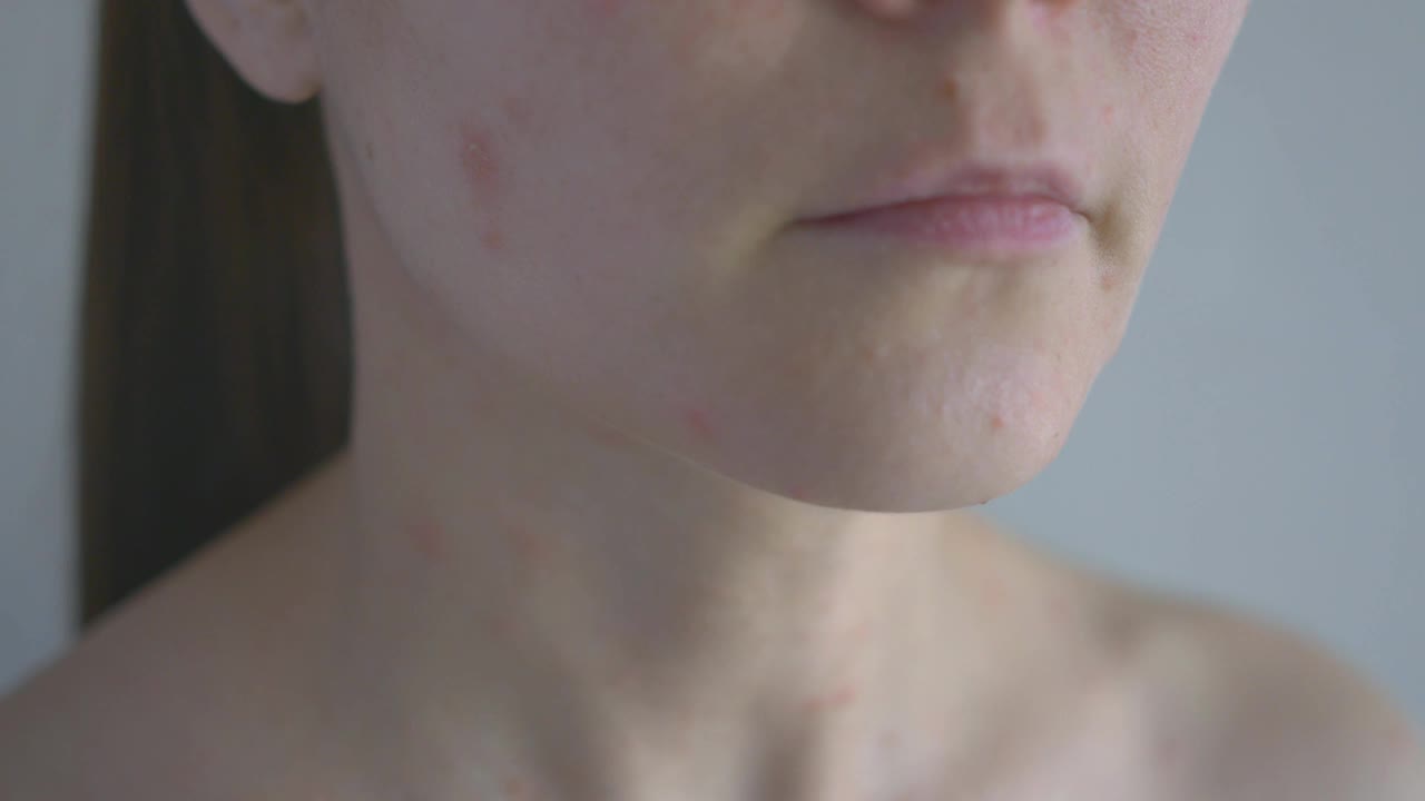 皮肤有问题的女人。在女性身体的面部和颈部区域，丘疹和痤疮颜色是浅红色的。过敏性皮炎。特写镜头视频素材