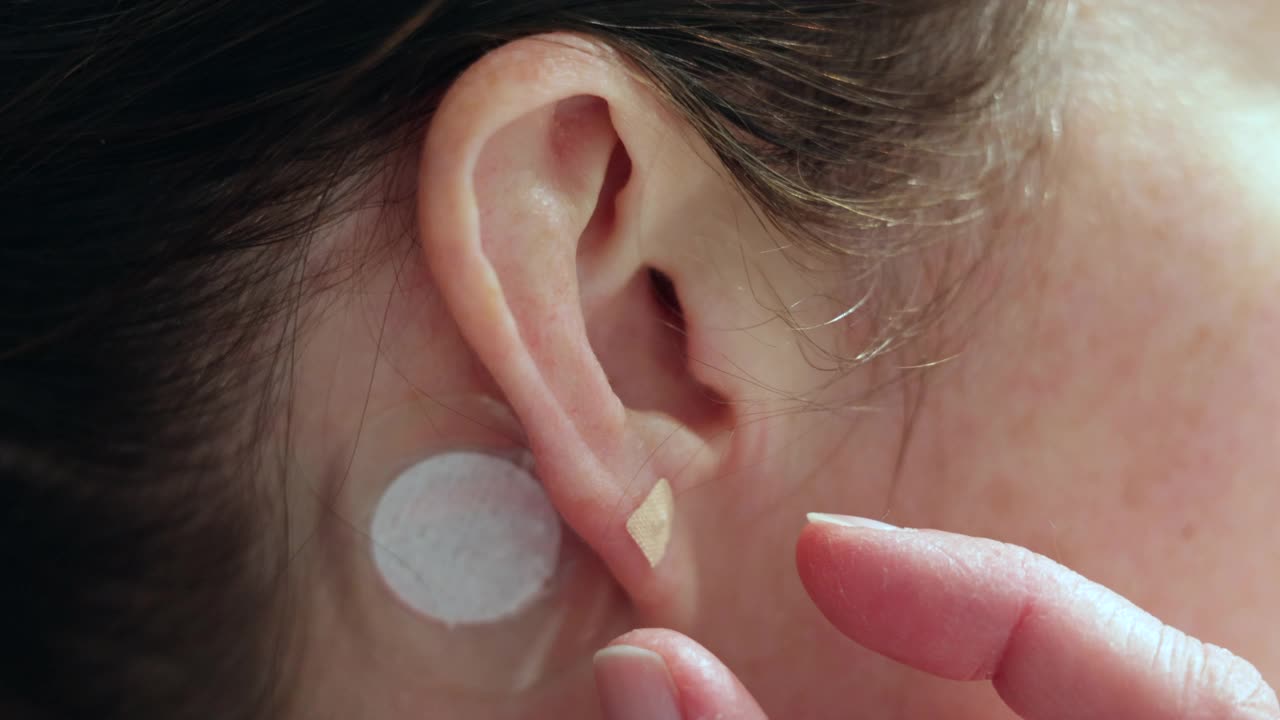 妇女在耳鸣问题上对针刺磁铁施加压力视频下载