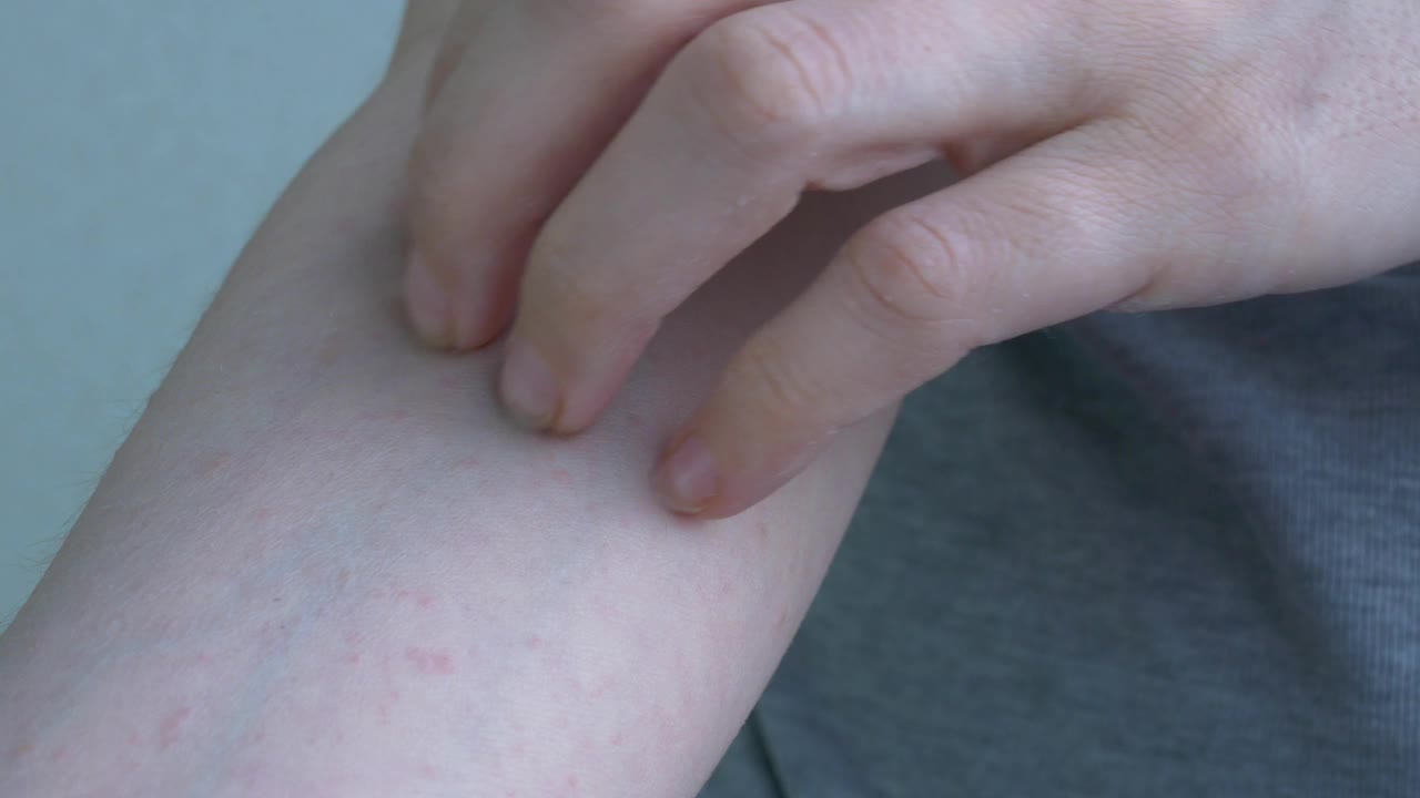从肘部到手的间隙，特写显示皮肤有浅粉色的小炎症。痒的皮肤被指甲划伤了。病毒性疾病。特写镜头视频下载