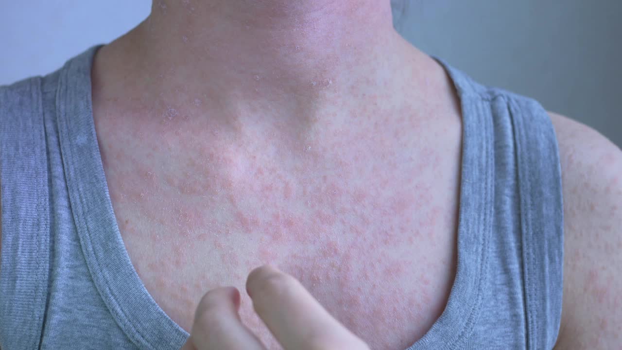 一段特写视频显示了这名女子的上胸部和肩膀。在身体的这些部位，出现浅红色的过敏性皮疹。皮肤被指甲划伤了。病毒性疾病视频下载