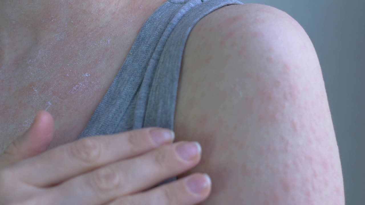 在女性皮肤的表面，前臂，特写，凸出，发炎，发红的斑点是可见的。这些斑点有点划痕。病毒性疾病视频下载