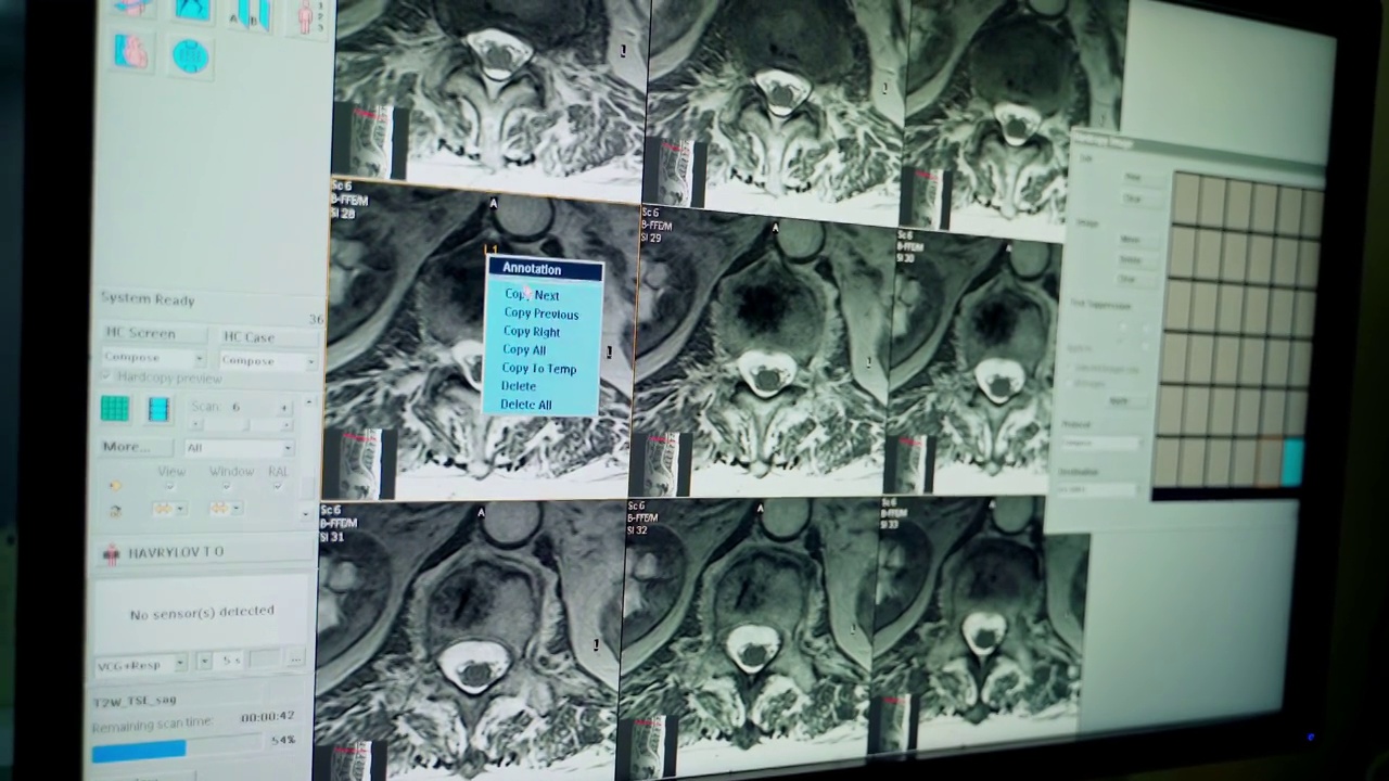 许多x射线的拼贴画。病人在医院的胸部x光片视频下载