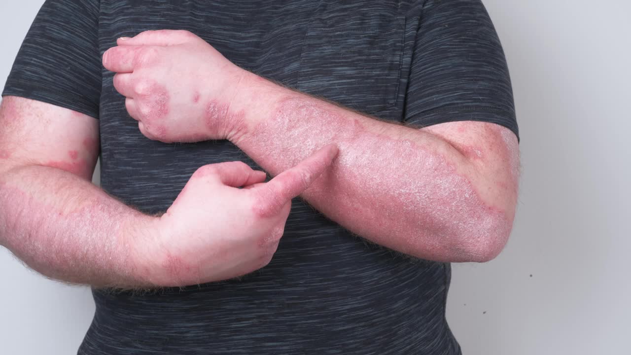 这家伙抓着满是牛皮癣的手，非常痒，牛皮癣的概念，干燥的皮肤疾病视频下载