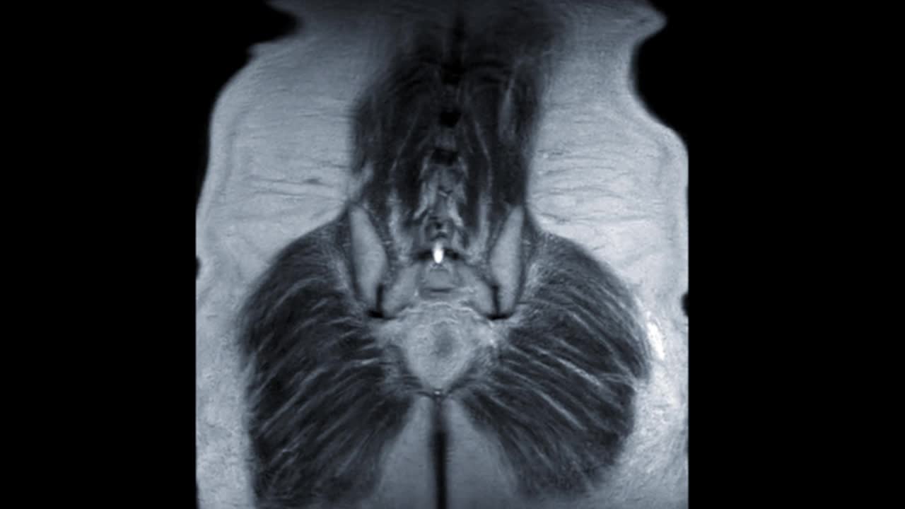 MRI前列腺冠状T2W图诊断老年男性前列腺癌细胞。视频下载