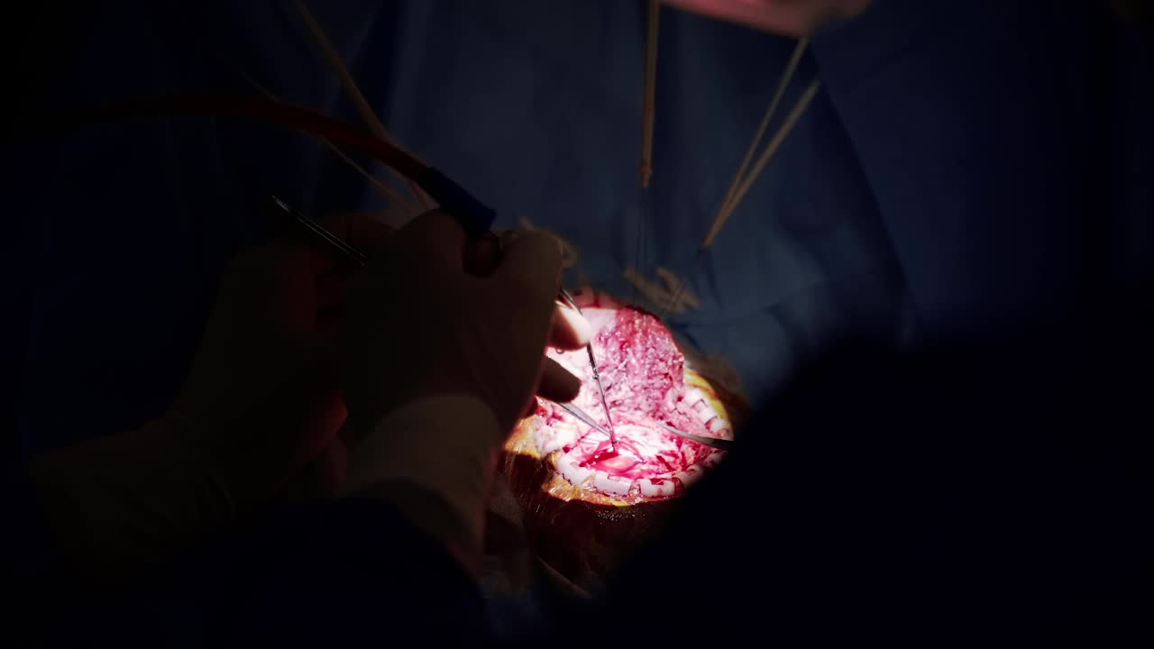 在黑暗中做手术的内脏。医生用手术工具为病人操作。特写镜头。视频下载