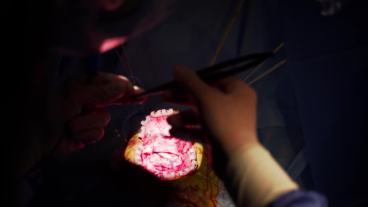 神经外科手术中病人的内脏。在黑色背景下，医生双手使用手术工具。手术过程中的亮点。特写镜头。前视图。视频下载