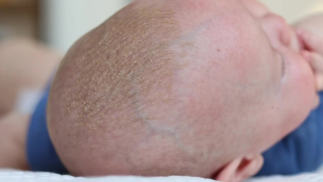 婴儿头部的摇篮帽或皮脂溢出的近景视频下载