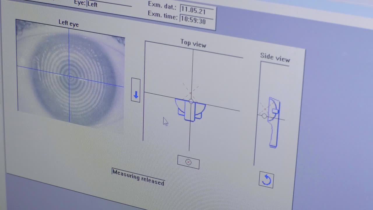 在眼科诊所检查期间眼的数字生物特征和断层扫描的屏幕查看结果视频下载