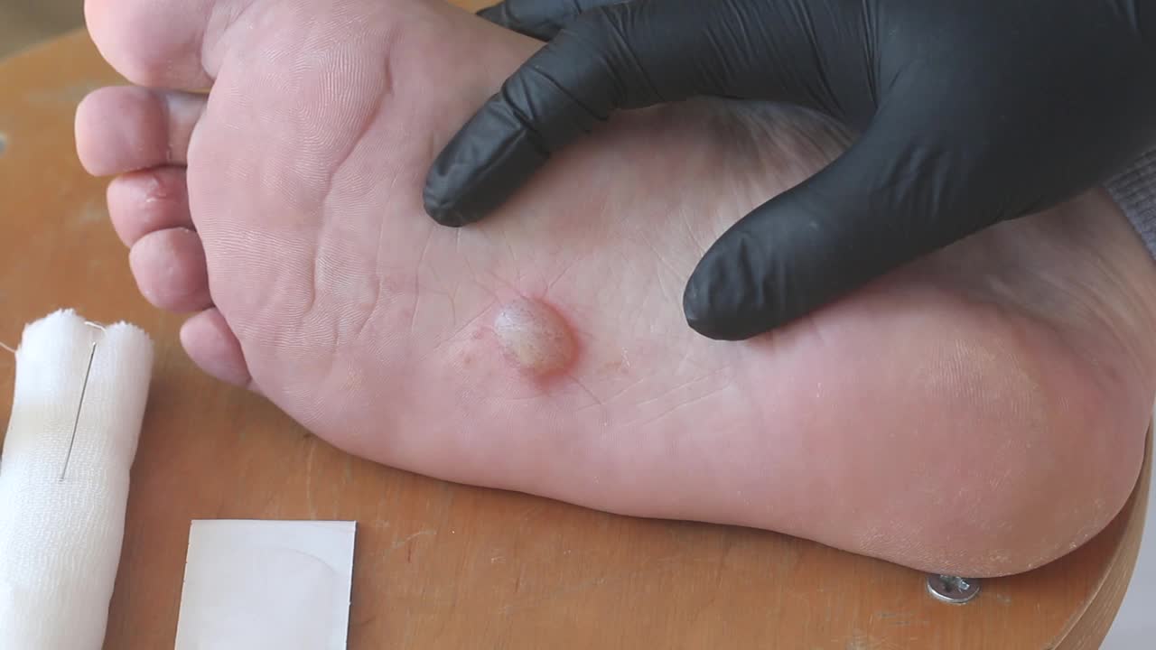 足部湿疹，皮炎。附近是绷带和石膏处理。特写镜头。视频下载