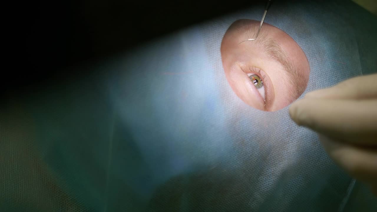病人的眼睛躺在手术室的桌子上的特写。激光视力矫正。诊所的眼科手术。视频下载