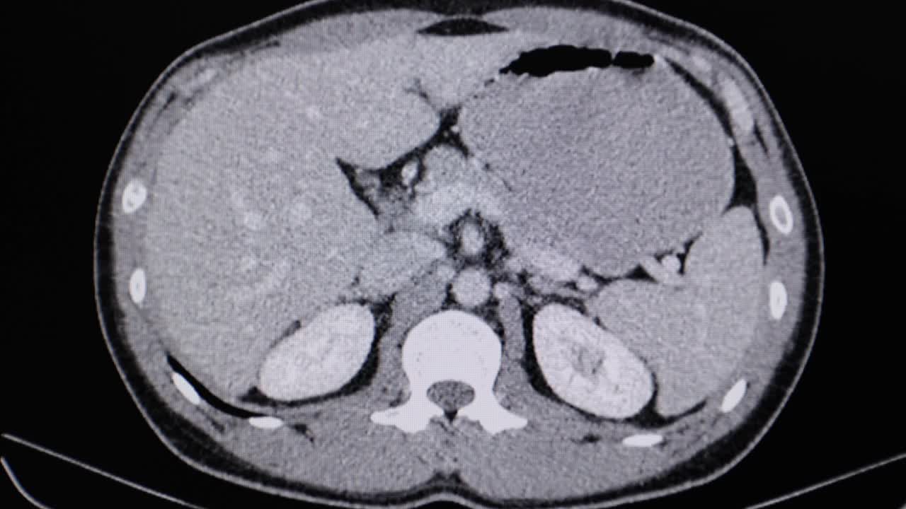 一位CA睾丸患者的腹部CT扫描视频下载