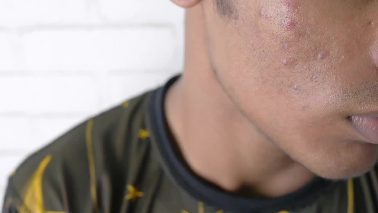年轻男子面对皮肤问题的特写。视频下载