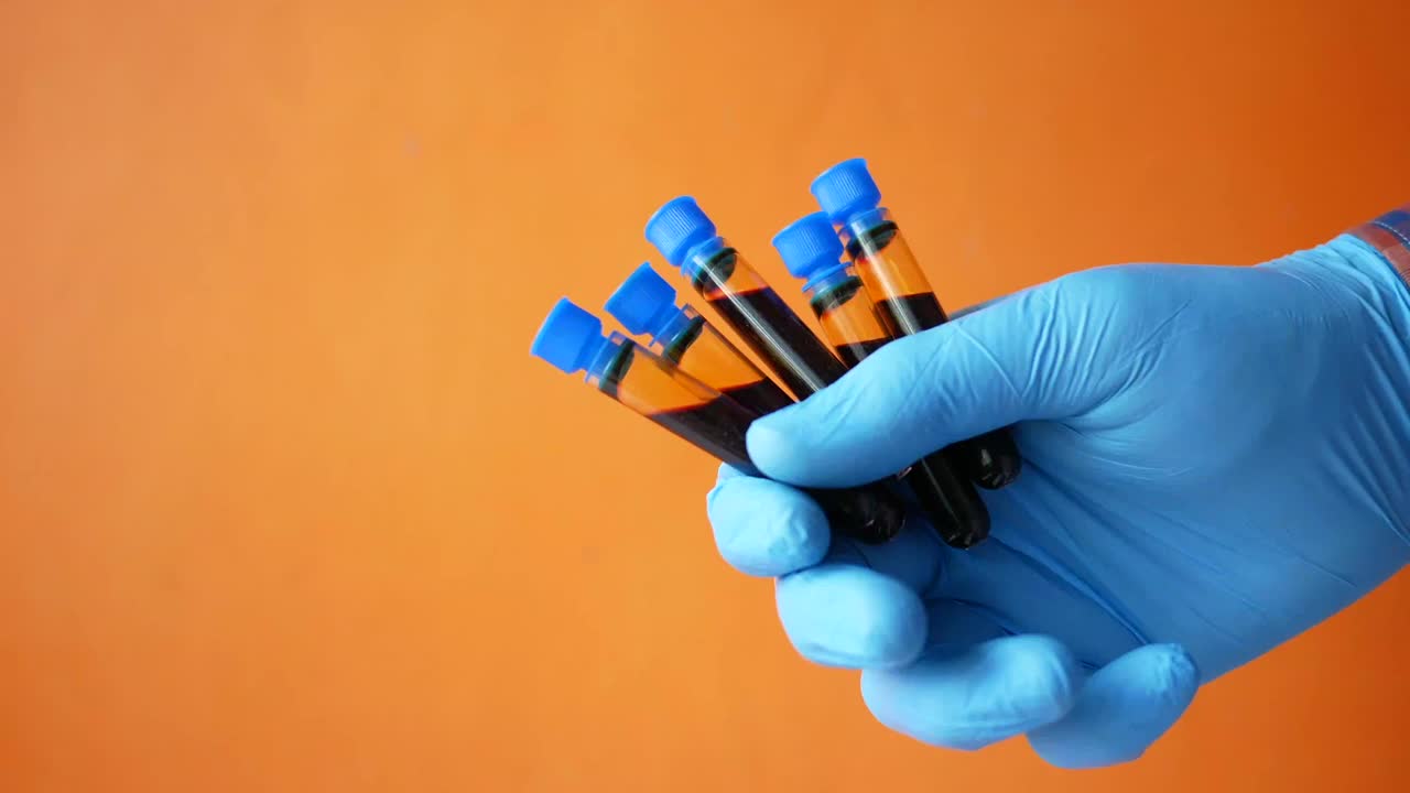 在橙色背景下手持血液试管的蓝色医用手套视频下载