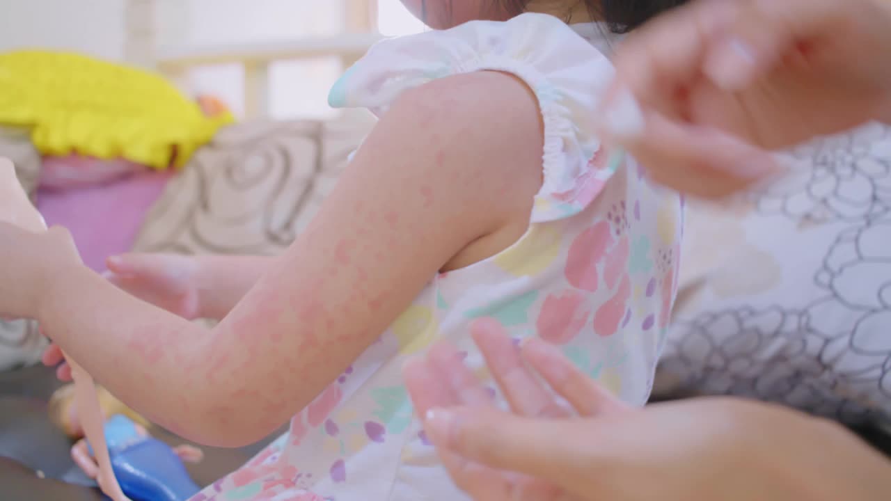 皮疹通常出现在蹒跚学步的女孩身上。过敏，孩子脸颊红肿视频素材