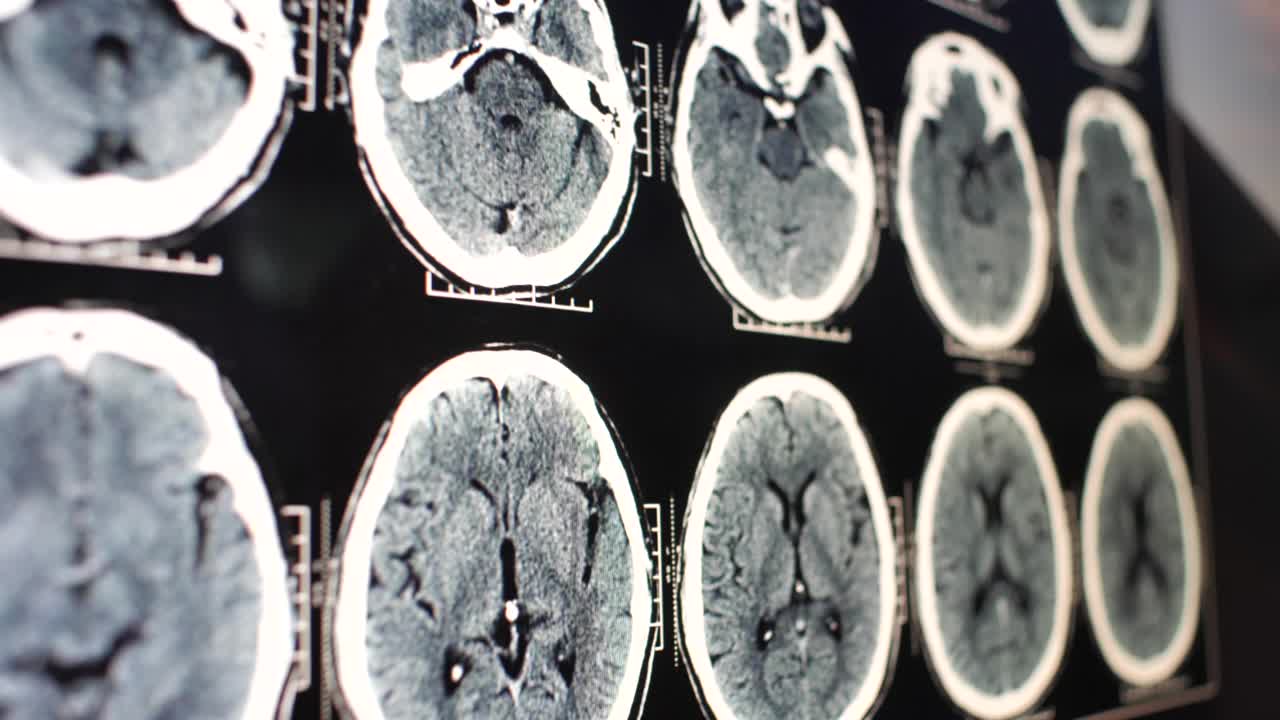 医生检查大脑的核磁共振成像视频素材