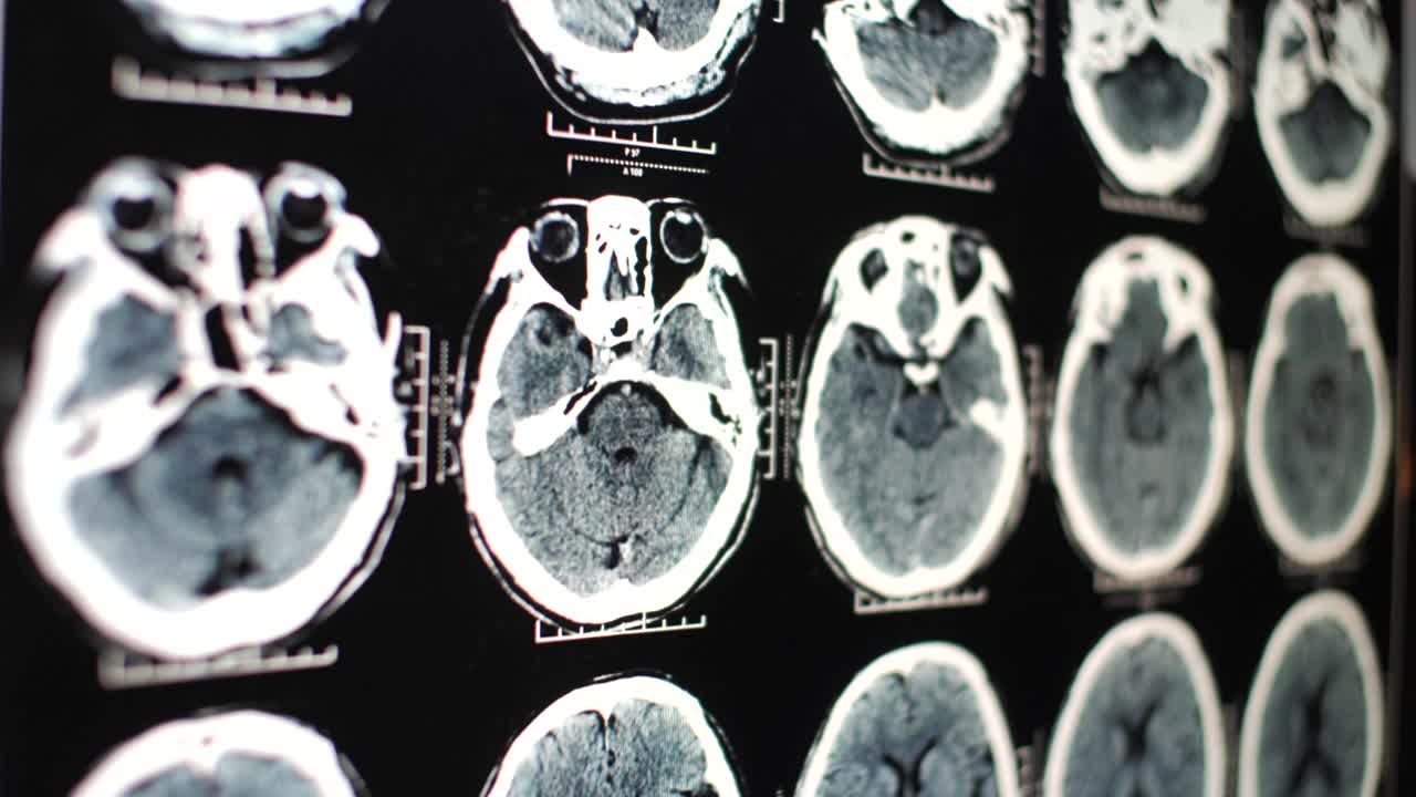 医生检查大脑的核磁共振成像视频素材