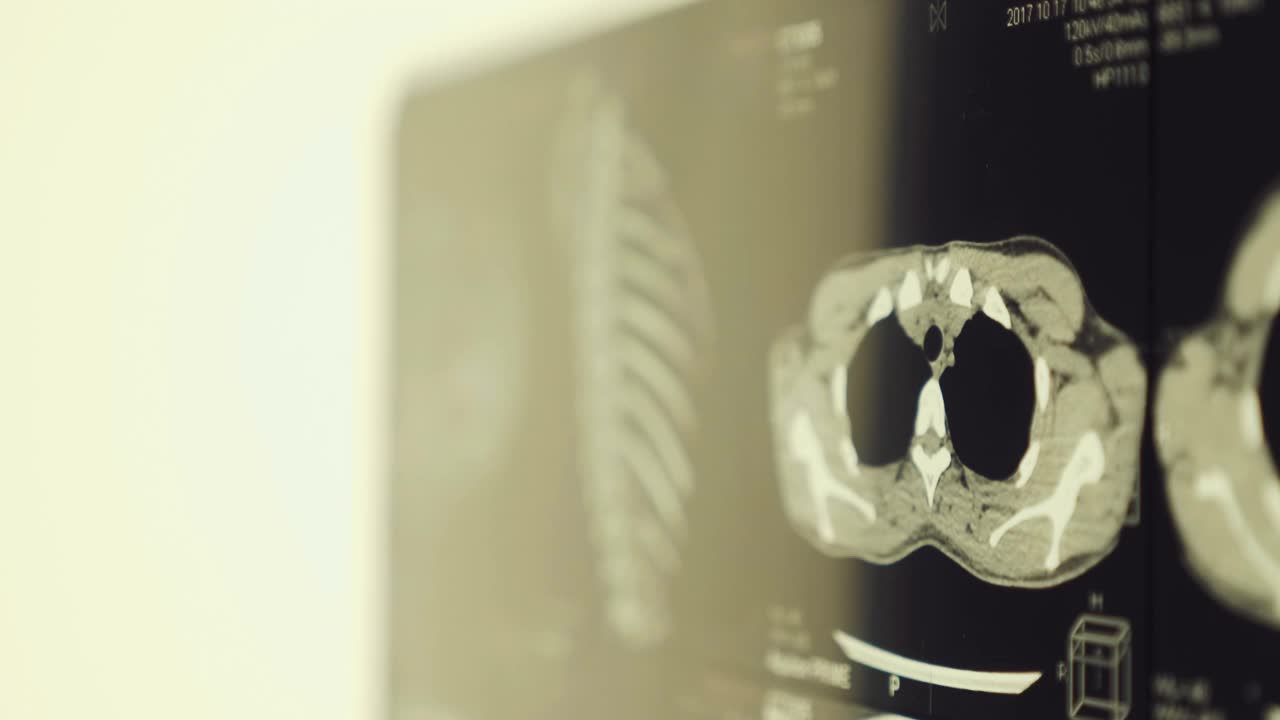 人体胸部、肋骨、脊柱和肺的磁共振成像(MRI)视频素材