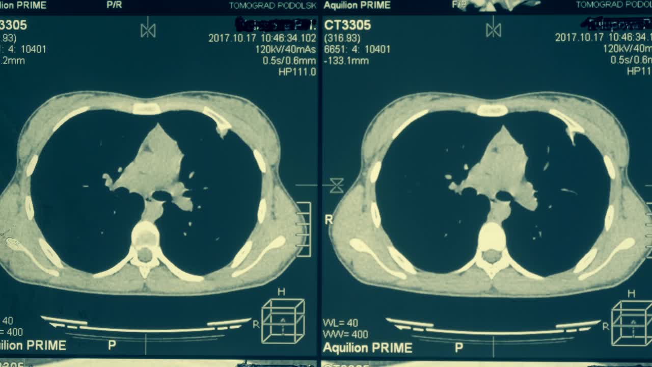 胸部和肺部的磁共振成像(MRI)视频素材