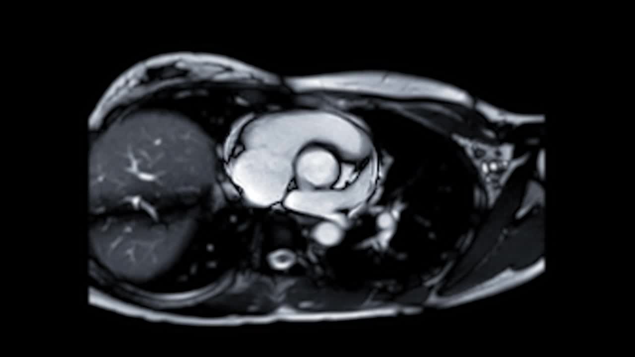 心脏核磁共振成像或心脏核磁共振成像(MRI)显示主动脉瓣检测心脏疾病。视频素材