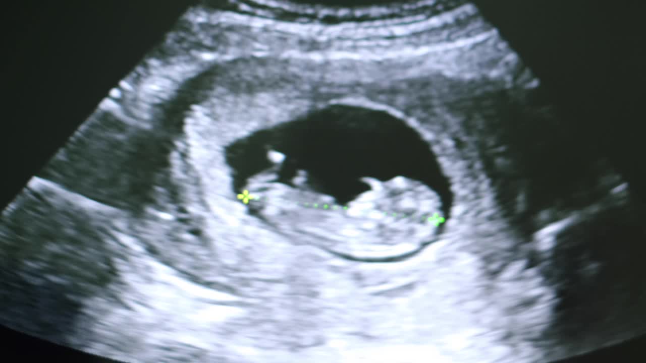 人类胚胎在超声波显示屏上轻微地移动着他的头视频素材