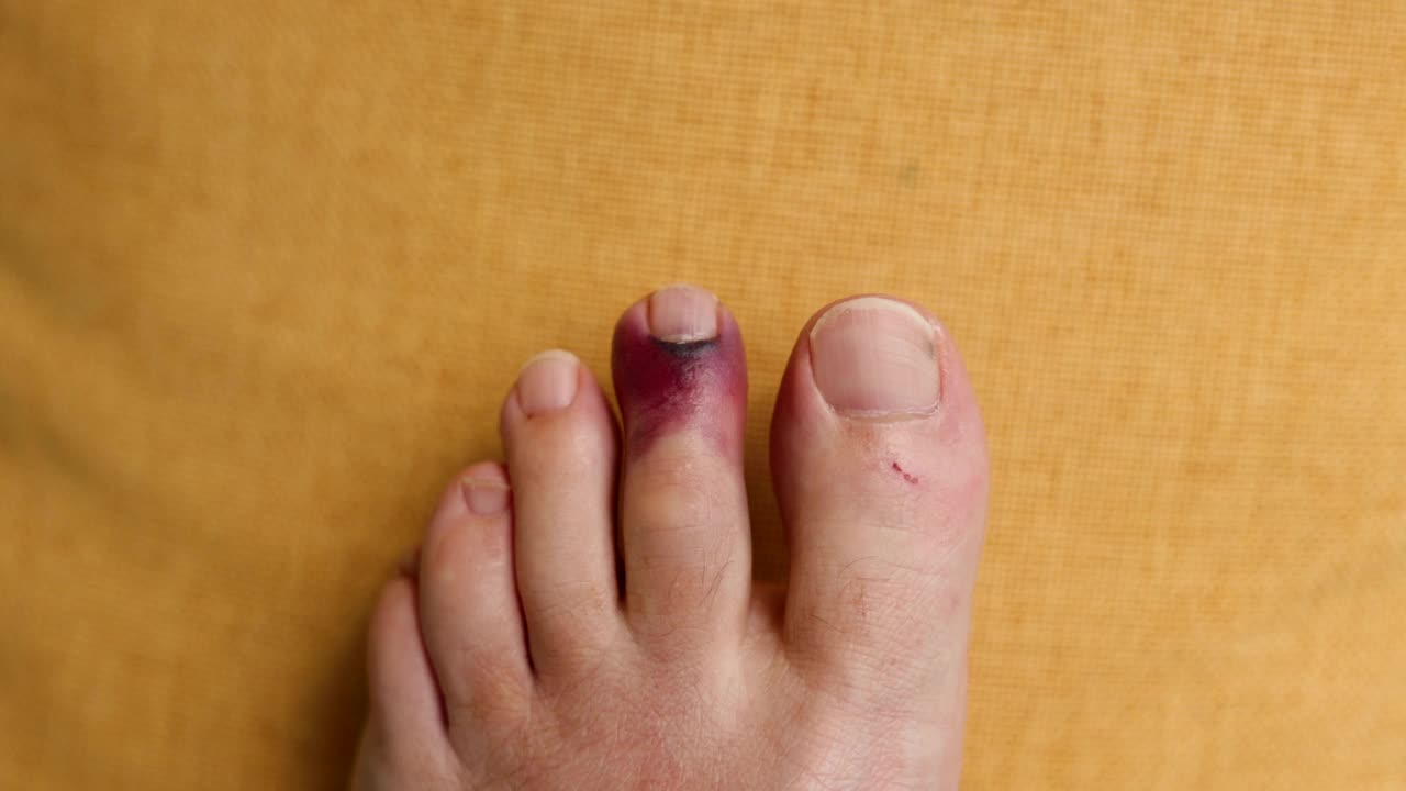 脚趾受伤的POV和b卷视频下载