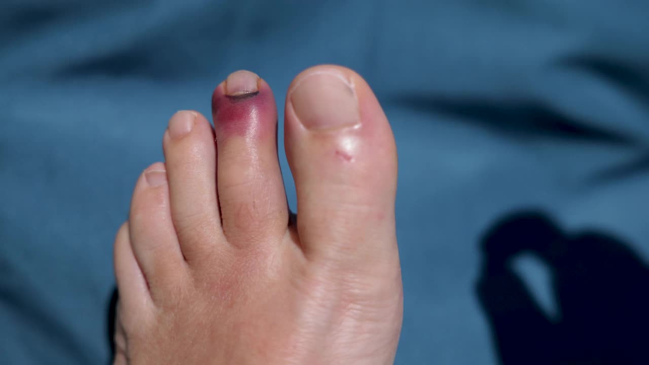 一个男人在肿伤的脚趾上涂药膏的时间视频下载