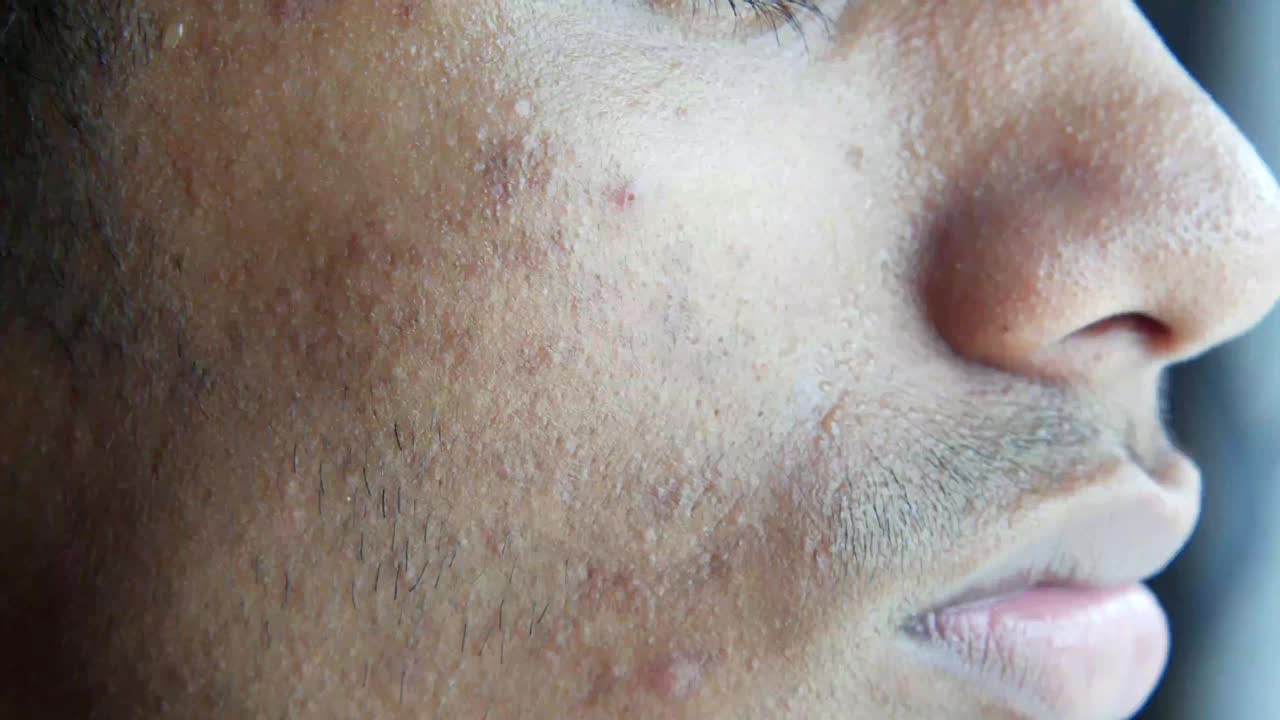 年轻男子脸部皮肤问题的特写。视频下载