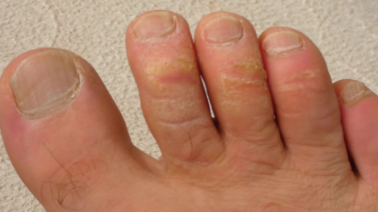 脚趾上的老茧和真菌疾病，被忽视的人类脚，视频下载