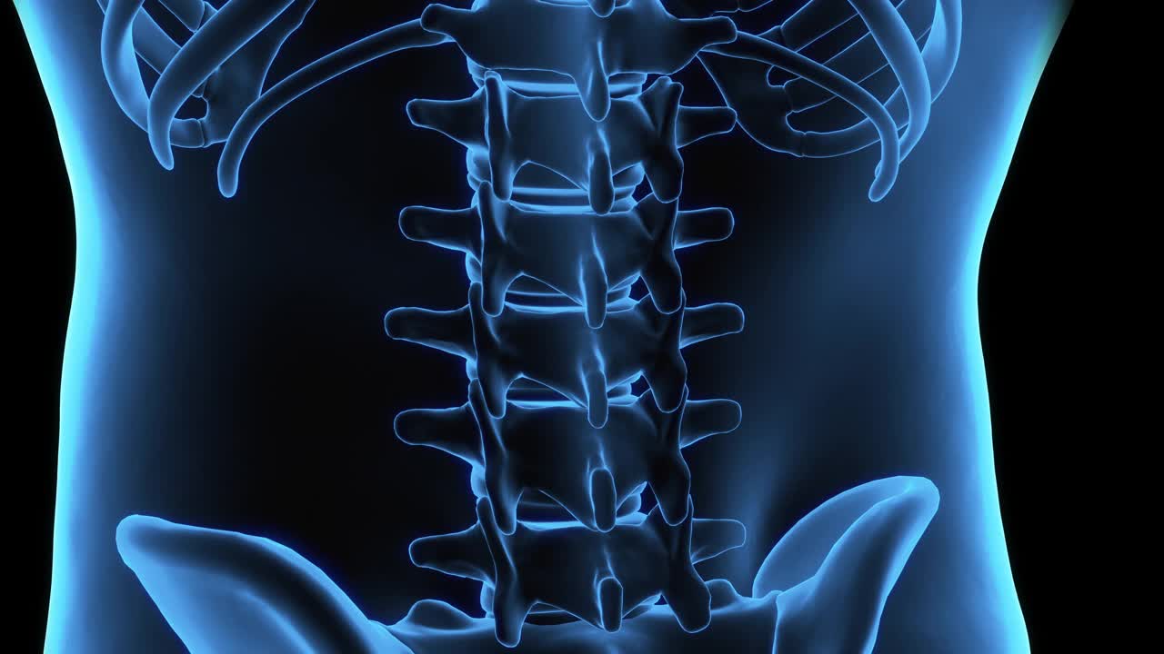 腰椎的3D计算机断层扫描和腰椎的x光片，显示从高处坠落后的胸腰椎骨折的创伤。医务人员的概念。视频下载