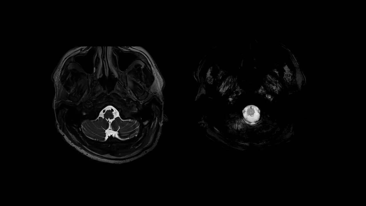 CT脑部核磁共振成像(MRI)视频素材