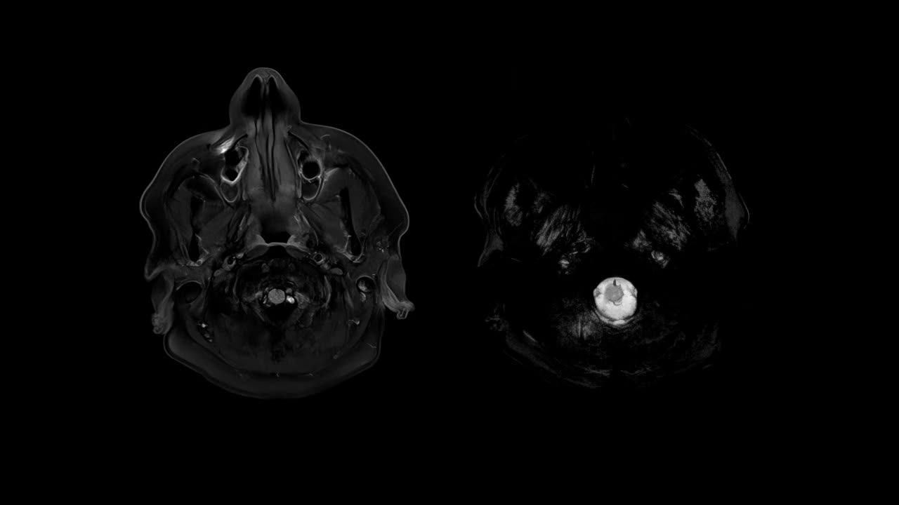 CT脑部核磁共振成像(MRI)视频素材
