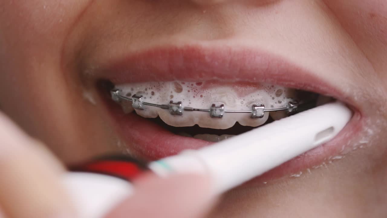 戴着牙套的孩子正在刷牙视频下载