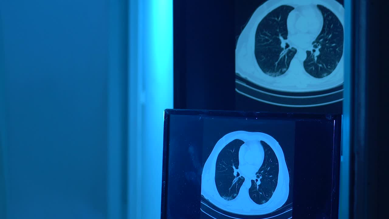 放射科门诊放射科医生检查患者胸部CT影像的高清视频视频素材
