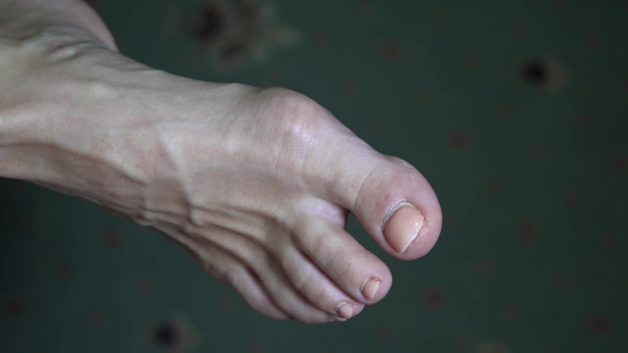 女人的脚结构不对。拇指侧骨的生长。把药膏涂在腿上的伤口上。视频下载