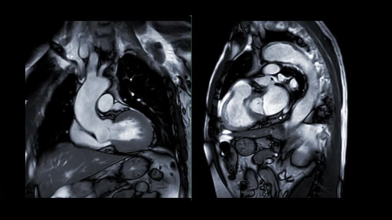 心脏MRI或心脏MRI(心脏磁共振成像)显示心脏跳动，以检测心脏病。视频素材