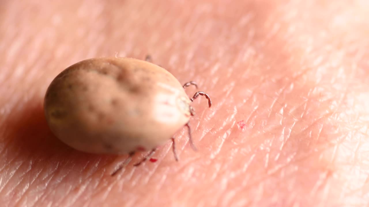 蜱虫在人的皮肤上。德国视频下载