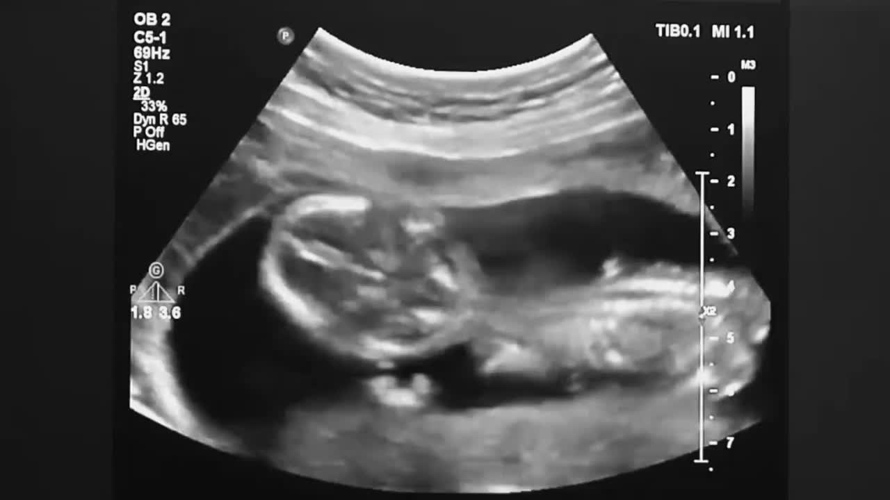 婴儿身体和脊椎的超声波。人类胚胎在超声波显示屏上轻微地移动着他的头。视频素材
