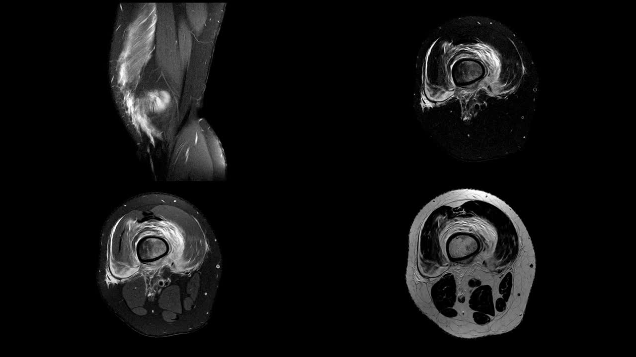 右膝MRI病史:15岁女性，右股骨病理性骨折。视频素材
