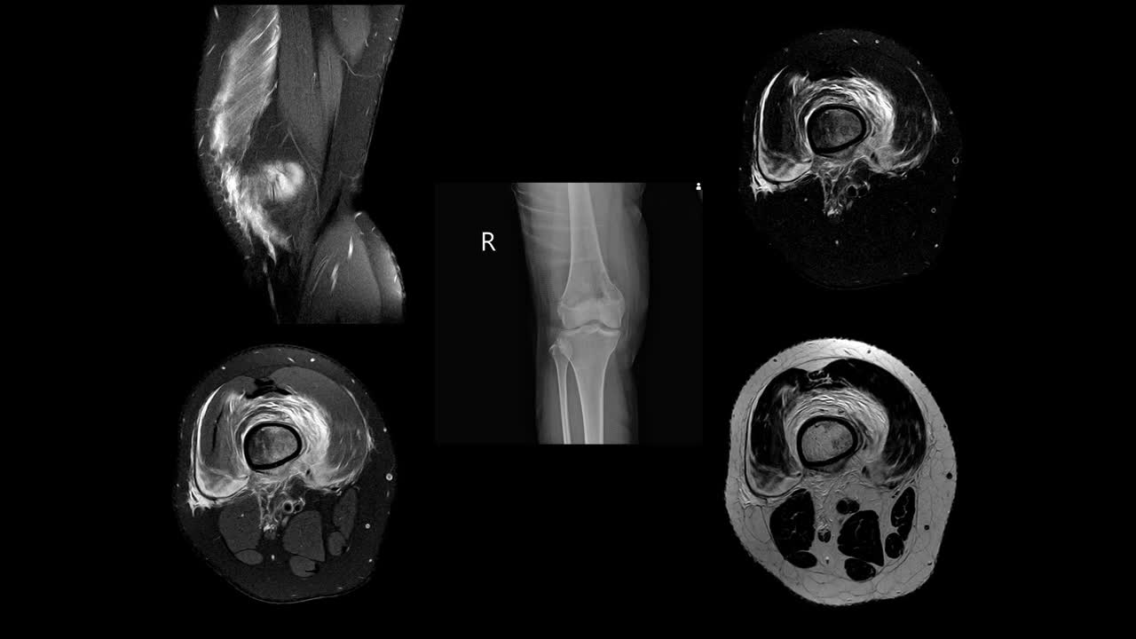 右膝MRI病史:15岁女性，右股骨病理性骨折视频素材
