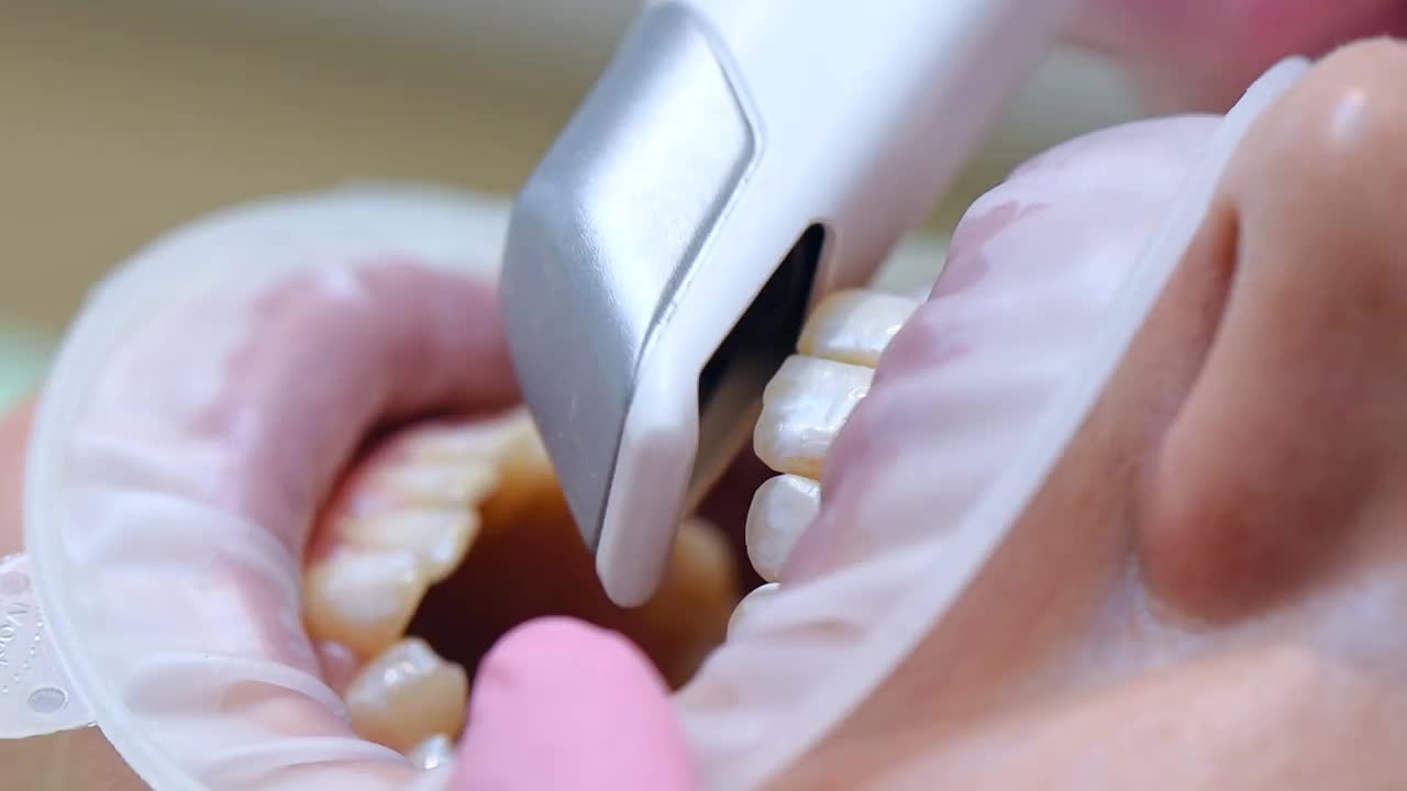 正畸医生用口腔内扫描仪扫描病人的牙齿视频下载