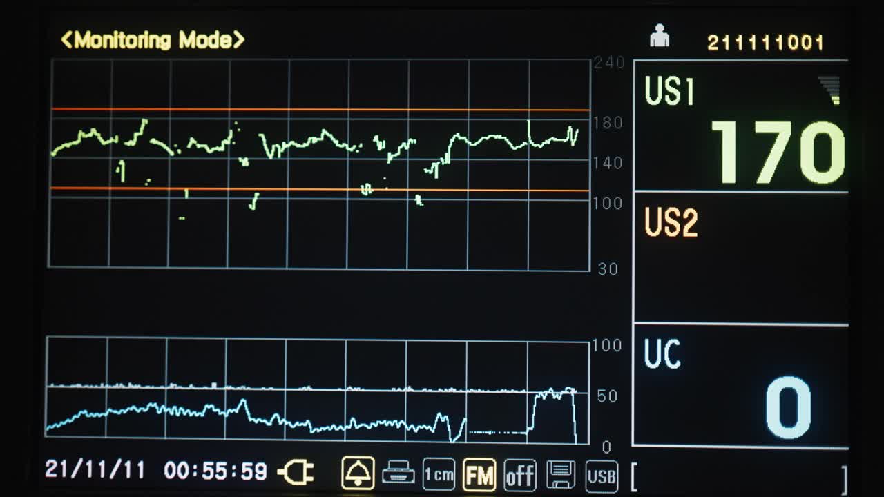 视频心血管内科ICU监护仪与住院患者生命体征视频下载