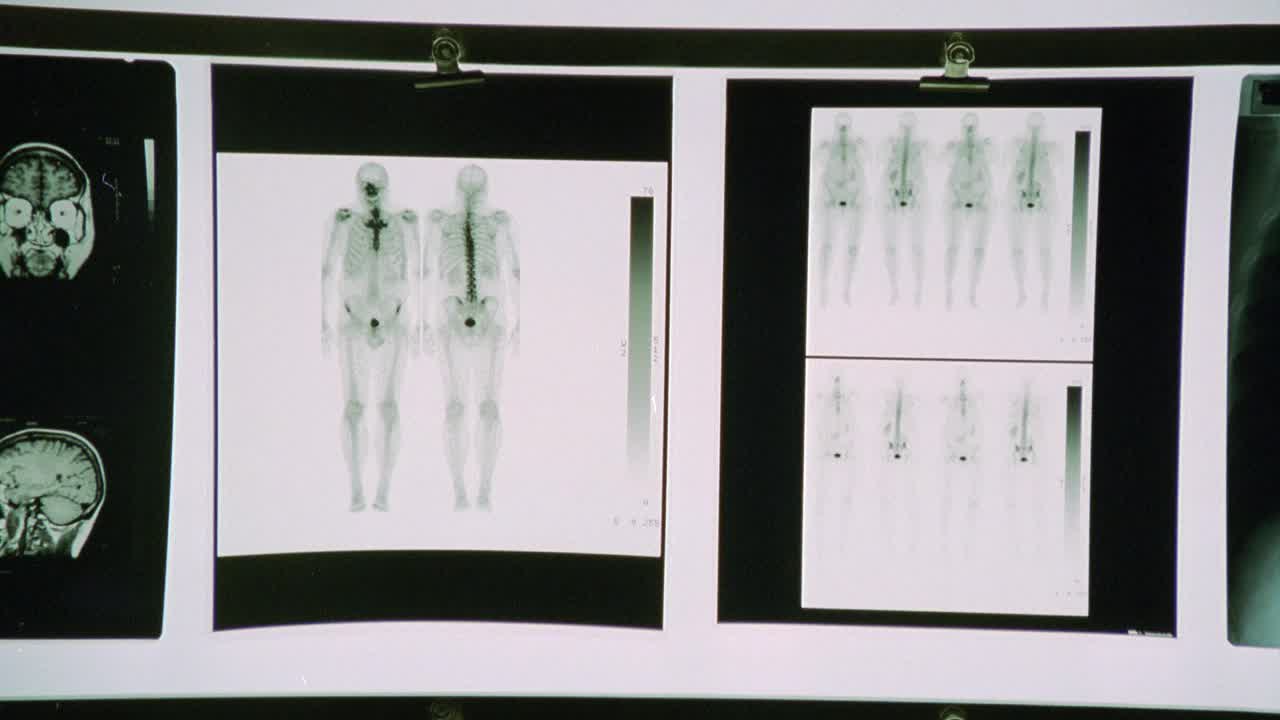 中角度的x光照片，包括骷髅和胸腔的照片。可能是医务室或急诊室视频下载