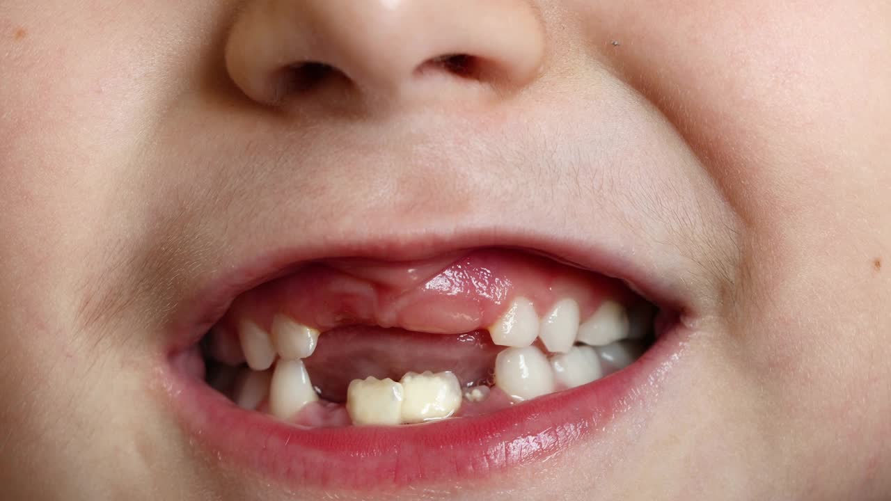 一个6-7岁的小女孩，刚长出牙齿。乳牙脱落。新牙视频素材
